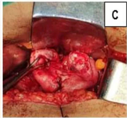 Figure 1: A: Uterine didelphys. B: Cavity opened. C: Edges of cavity approximated and sutured.