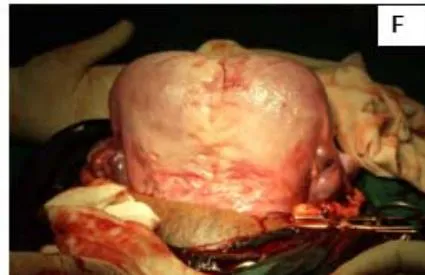Figure 4: A: HSG s/o Bicornuate uterus. B: Bicornuate uterus. C: Temporary ligation with Foley and opening uterine cavity. D and E: Anterior and posterior surface after suturing. F: Healed uterus as seen during Caesarean section.