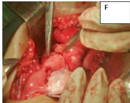 Figure 2: A: HSG s/o Bicornuate uterus. B: Bicornuate uterus on laparotomy. C: Vasopressin injected to minimize the blood loss during surgery. D: Transverse incision taken over uterine fundus. E: Uterine cavity opened. F: Edges approximated & sutured vertically