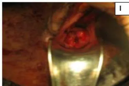 Figure 5: A: Uterine didelphys. B: Opening cavity during metroplasty. C: Complete vertical septum infiltrated with saline. D: Vaginal canals opening into two separate cervical openings. E: Anterior lip of cervices held with Allis' forceps and vertical incision taken over septum. F: Plane of dissection maintained along the septum. G: Redundant mucosa cut. H: Cut ends sutured with vagina with Vicryl 3-0. I: Vagina with two cervices.