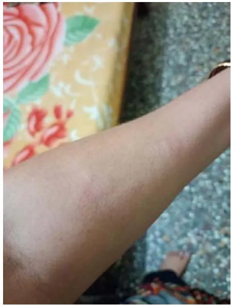 Fig 2: Skin Prick Test Showing Rash at the Site of Degludec Injection