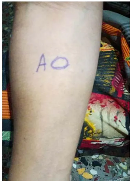 Fig 3: Skin Prick Test Was Not Showing Any Rash at the Site of Aspart Injection