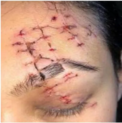 Figure 7: Mar/7/2020 - Wound after stitch removal