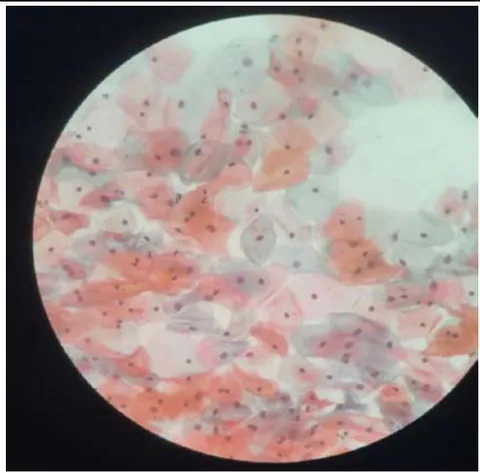 Figure 4: Normal smear - Patient B (post-procedure). Figures 1 and 3 show pre-procedure images of vaginal epithelial cells with severe atrophy and low cellularity. Figures 2 and 4 show smears demonstrating post-procedure recovery of vaginal cellularity and normal epithelium.
