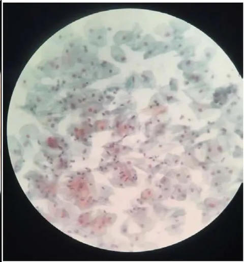 Figure 2: Normal smear- Patient A (post-procedure).