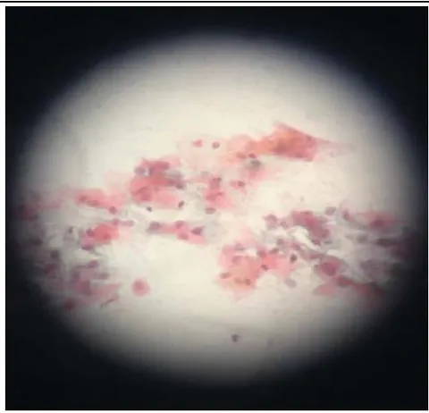 Figure 3: Atrophic smear- Patient B (pre-procedure).