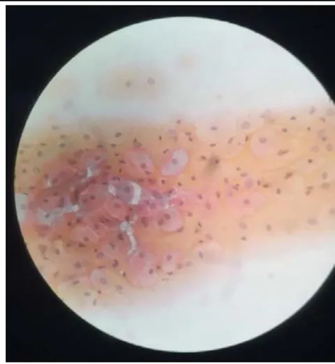 Figure 1: Atrophic smear - Patient A (pre-procedure).