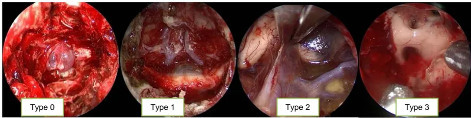 Fig. 1: Type of surgical cavity in relation to the intracranial hydrodynamic system. Type 0: no contact with the hydrodynamic system, Type 1: subarachnoid contact and dissection, Type 2: cisternal dissection, in this case in the interpeduncular cistern, Type 3: dissection inside the third ventricle.