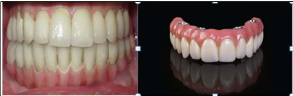 Fig. 3: PFM Vs Hybrid Prosthesis after Full Mouth Implant Therapy