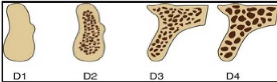 Fig. 1: Mischs Classification of Different Bone Densities