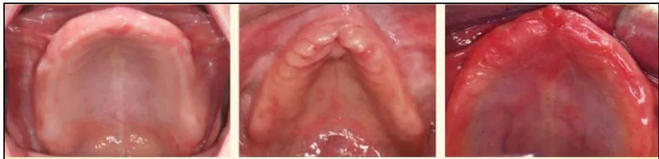 Fig. 2: U, V, U-V tapered arch forms all requiring different number of implants for rehabilitation