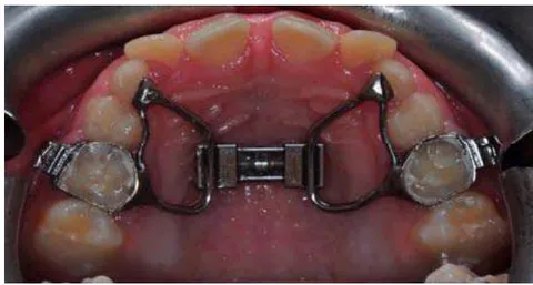 Figure 2: RPE Device