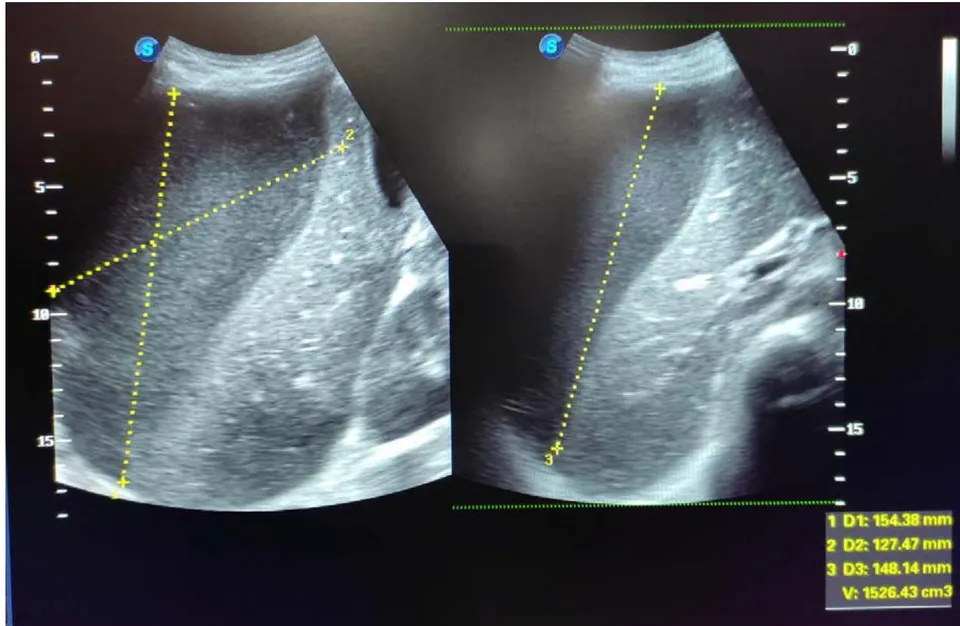 Figure 1: Ultrasonography of abdomen showing 1500cc right sub-phrenic collection pushing liver down.