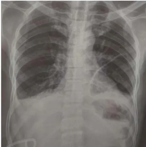 Figure 3: Post-procedure roentgenogram of chest and abdomen showing right minimal pleural effusion and right-sided pigtail catheter in situ.