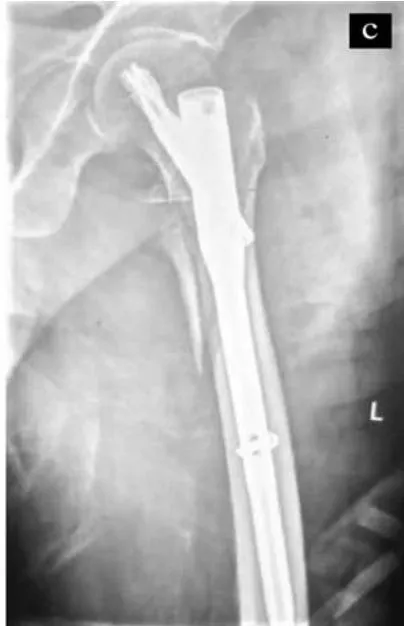 Figure 2: Show a 31.A2.3 fracture in 84-year male from Post-C group with acceptable reduction