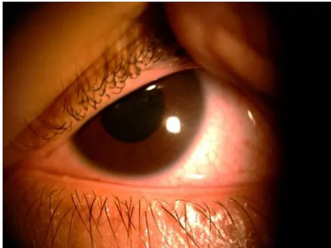 Figure 1: Corneal crystal deposits.