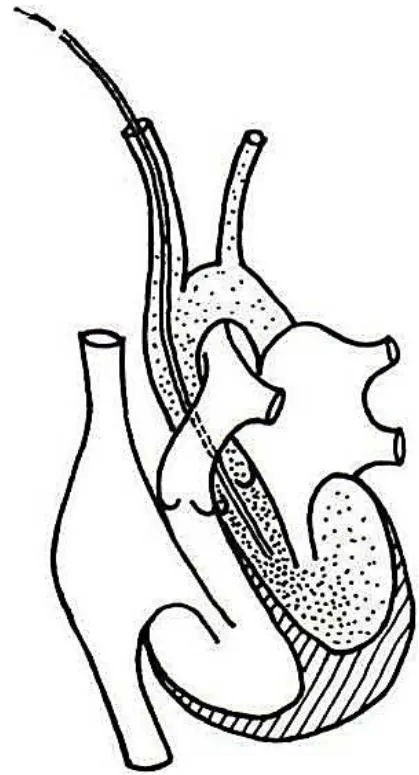 Figure 2: Schematics of experimental bacterial elimination from the LV into the arterial circulation