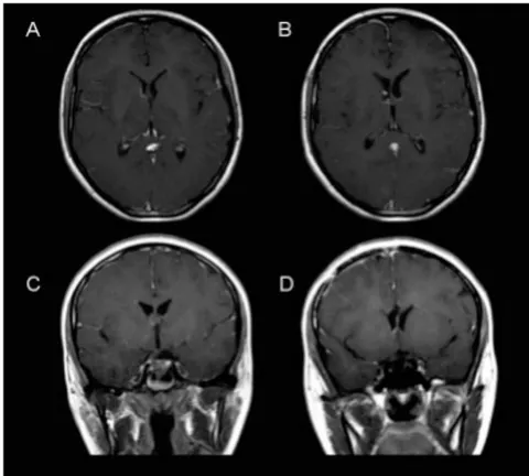 Figure 3: Postoperative MRI: T1 with gadolinium, axial (A and B) and coronal (C and D) planes. Small residual focus near the foramen of Monro, attached to the thalamostriate vein (identified during the transoperative period).