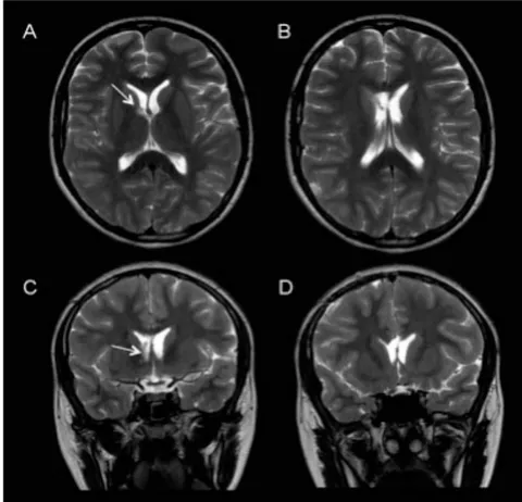 Figure 4: Postoperative MRI: T2 axial (A and B) and coronal (C and D). Small residual focus at the level of the foramen of Monro (arrows).