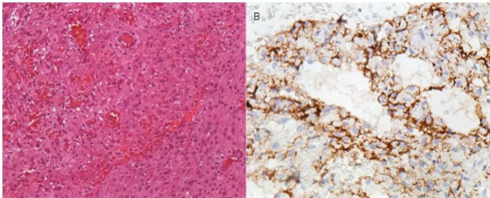 Figure 1: Preoperative MRI: A and B β T1 with gadolinium, axial (A) and coronal (B). Lesion with intense uptake at the level of the right frontal horn, close to the foramen of Monro. C and D β T2 axial(C) e coronal(D). Hyperintense lesion, with a focus of hypointense calcification (also seen in A). Figure 2: A β Hematoxylin and eosin staining, 200 times magnification: image showing histopathological features of meningioma and significant vascular component. B β Immunohistochemistry, 400-fold magnification: tumor cells showing positivity for EMA.