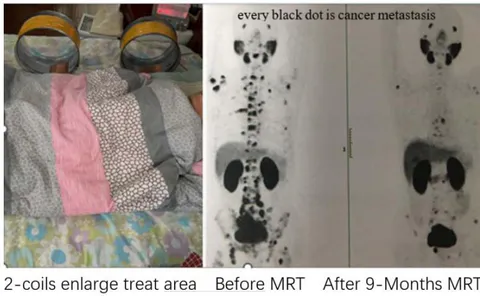 Fig. 12: MRT Treated Prostate Cancer