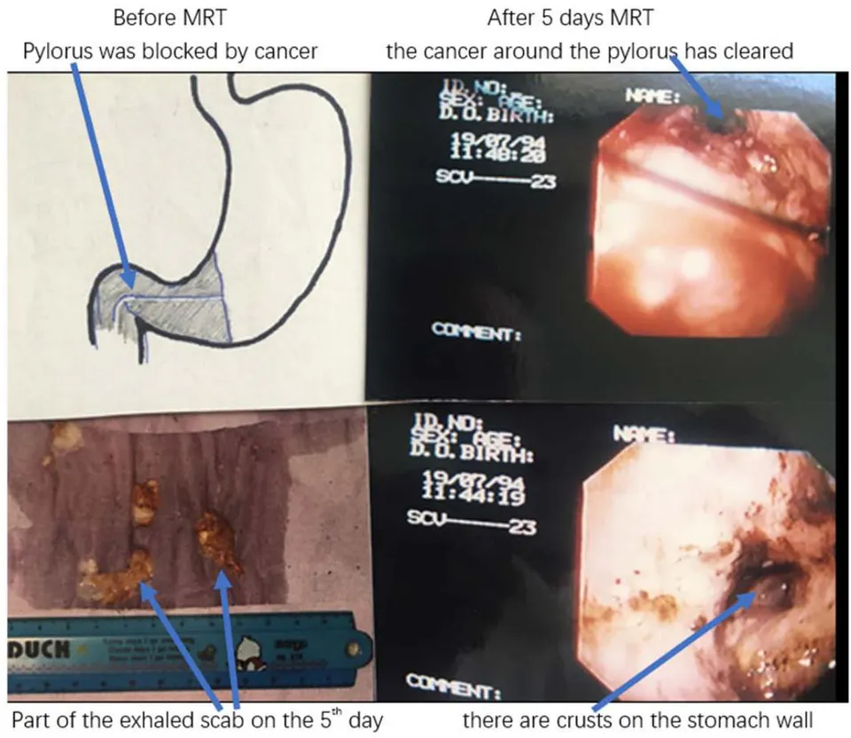 Fig. 9: 5 Days MRT (3hours/day) Cure the Pylorus Cancer
