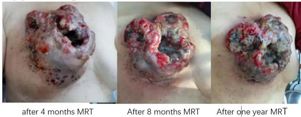 Fig. 11: MRT Treated Breast Small Cell Cancer