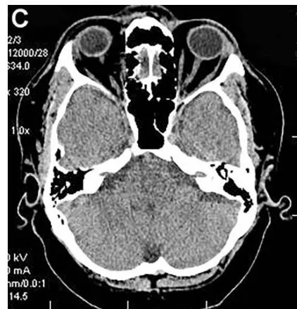 Figure 3: Same patient S., 42 years old, male.