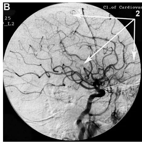 Figure 2: Patient P., 75 years old, female. Medical history of AD - 12 years, TDR-3.