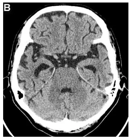 Figure 4: Same patient P., 75 years old, female TDR-3.
