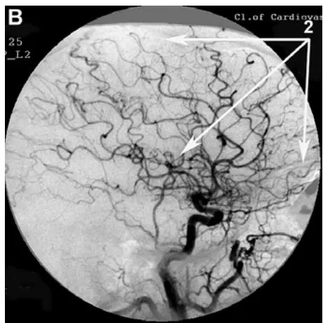 Figure 1: Patient S., 42 years old, male. Medical history of AD - 2 years, TDR-1.