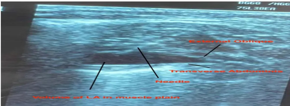 Fig. 3: Trans Abdominal Plain Block