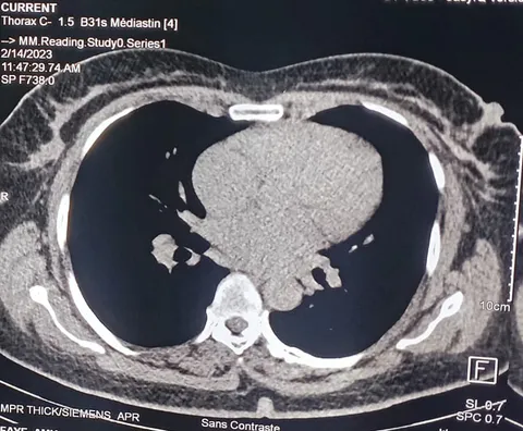 Chest CT angiography showing interstitial lung disease
