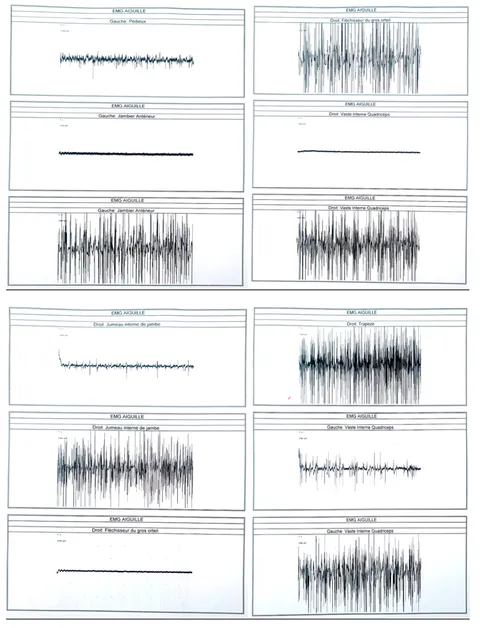 Electromyography showing fibrillation potentials in the left extensor digitorum brevis, right medial gastrocnemius, and left quadriceps