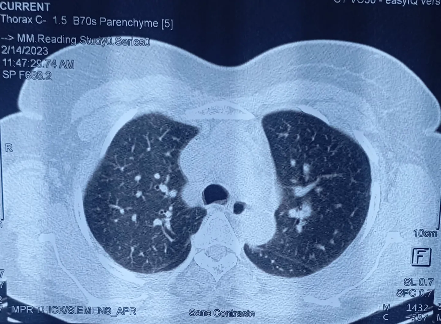 Chest CT angiography showing interstitial lung disease