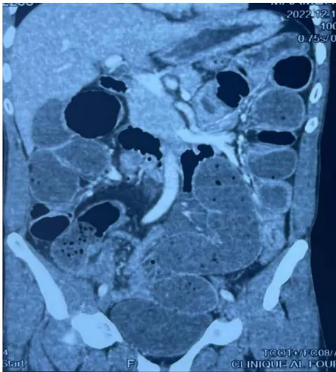 Figure 1: Caliber disparity in the right iliac fossa