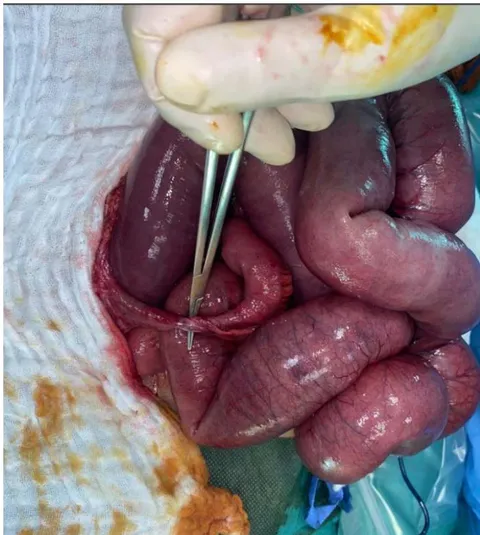 Figure 3: Meckel's diverticulum adhering to the abdominal wall