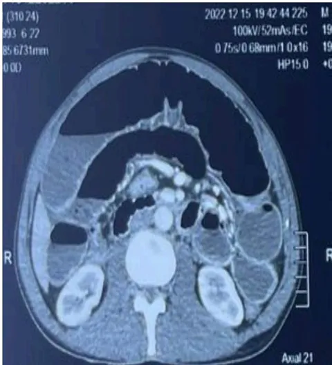 Figure 2: Air-fluid levels
