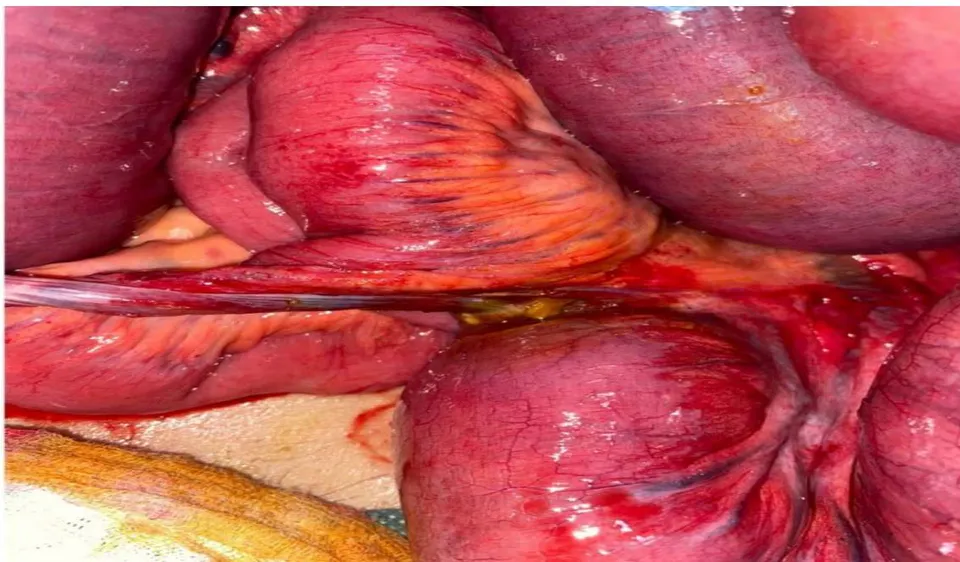 Figure 4: Meckel's diverticulum becoming free Figure 5: A. Meckel's diverticulum-B. perforative lesions