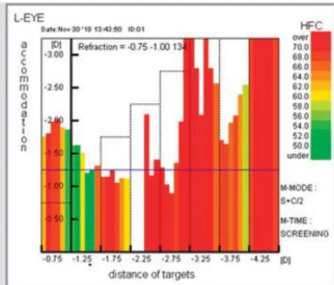 Fig. 2: Accomodogram of a child with low myopia. Autorefractometer Righton Speedy-K ver. MF-1