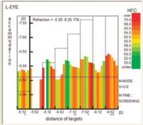 Fig. 4: Accomodogram of a child with high myopia. Autorefractometer Righton Speedy-K ver. MF-1