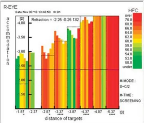 Fig. 1: Accomodogram of a child with emmetropia. Autorefractometer Righton Speedy-K ver. MF-1