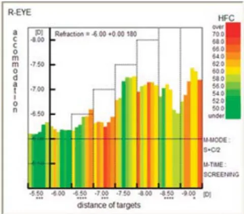 Fig. 3: Accomodogram of a child with moderate myopia. Autorefractometer Righton Speedy-K ver. MF-1
