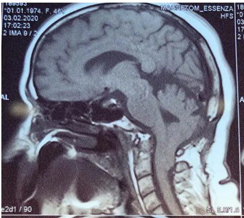 Figure 1: An example of MRI of patient S., with Chiari malformation of type 1 with ectopia of cerebellar tonsils 14mm on the right and 12mm on the left Figure 2: MRI of patient Z., 34 years old, with an anomaly of the craniovertebral junction with displacement of the cerebellar tonsils below the Chamberlain line up to 24 mm from 2 sides