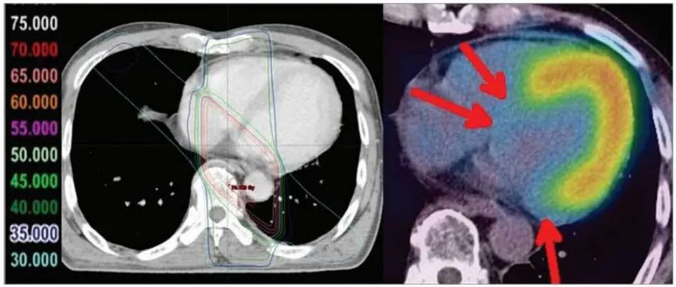 Fig. 3. Images of a remarkable case (62-year-old male) at 29 months after radiotherapy for esophageal cancer. Reduced uptake corresponding to radiation fields was distinct in this case.