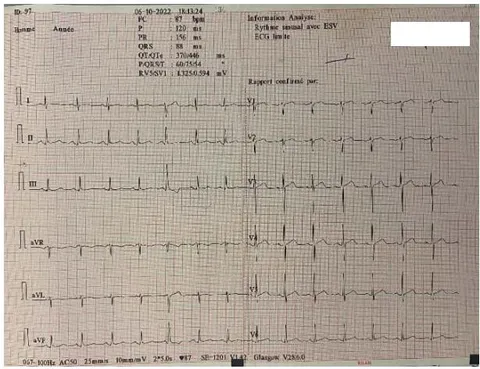 Figure 1: Normal EKG of the Patient