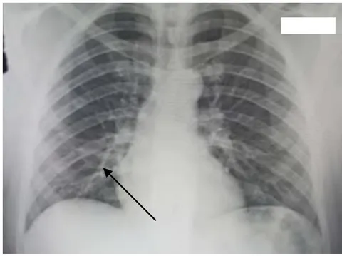 Figure 2: Right basal Image on Chest X-Ray