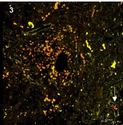 Figure 3: Viral expression in platelets in liver fragments from HCV patients: histological analysis using fluorescent markers. 1) Expression of NS4A on platelet surface; 2) CD61, platelet marker; 3) Overlay of NS4A and CD61. The arrows indicate HCV+ platelets in the blood vessels.