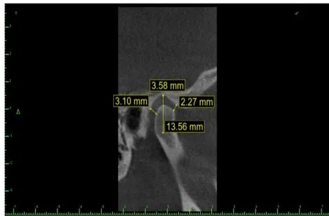 Figure 2: Illustration of axial cut measurements
