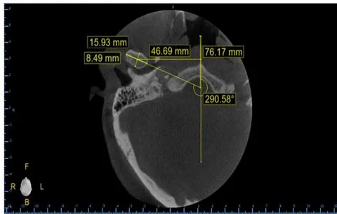 Figure 4: Axial cut measurements
